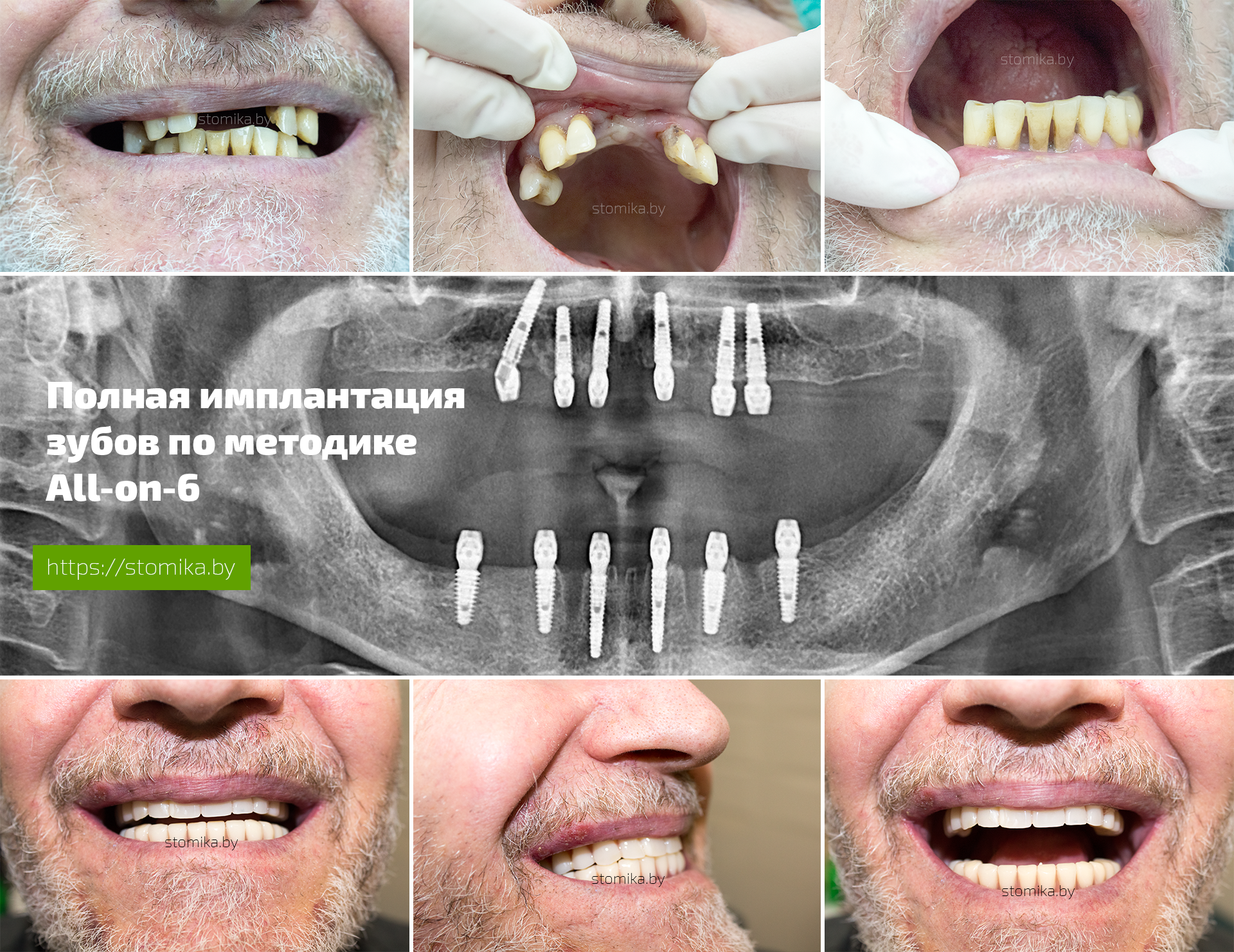 Диета Перед Имплантацией Зубов