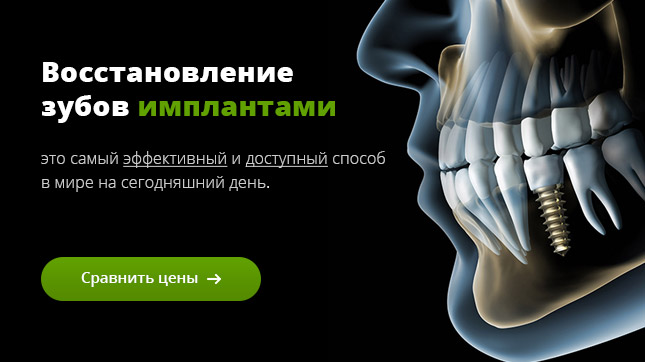 Восстановление зубов имплантами в Минске