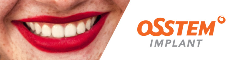 Имплантация на имплантах Osstem в Минске