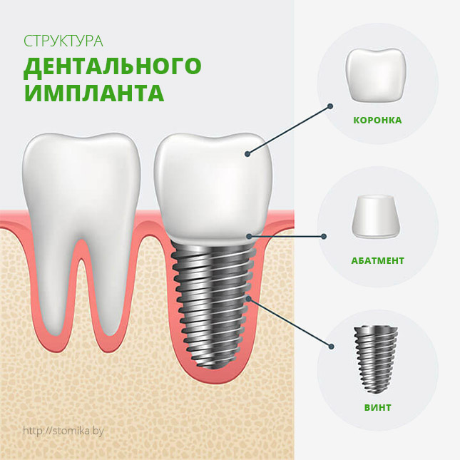 Структура дентального импланта