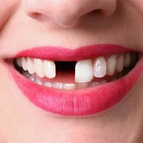 Имплантация показана при отсутствии одного зуба