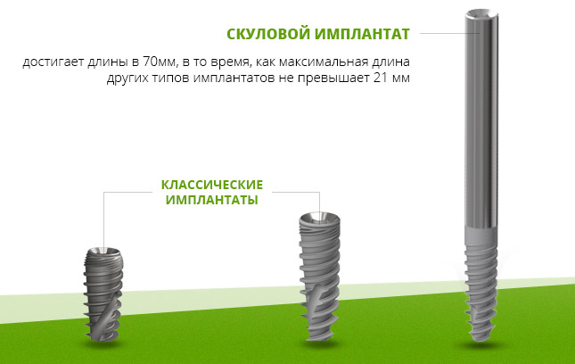 Скуловой имплантат может достигать длины - 70мм.
