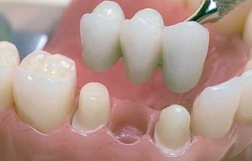Цельнолитые зубные коронки в Минске