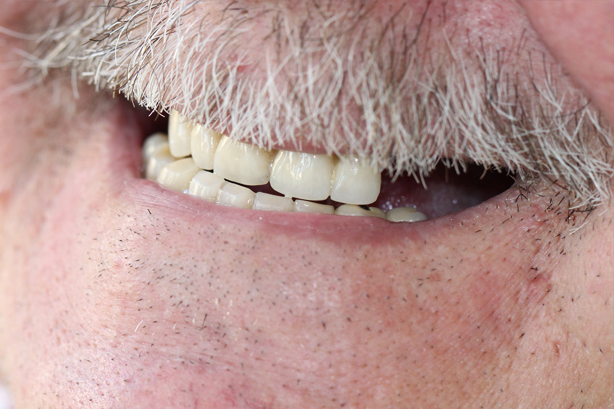 Состояние зубов пациента до имплнатации All-on-6