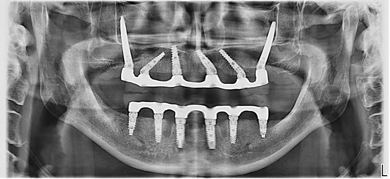 ОПТГ снимок после операции