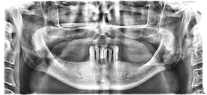 ОПТГ снимок до имплантации