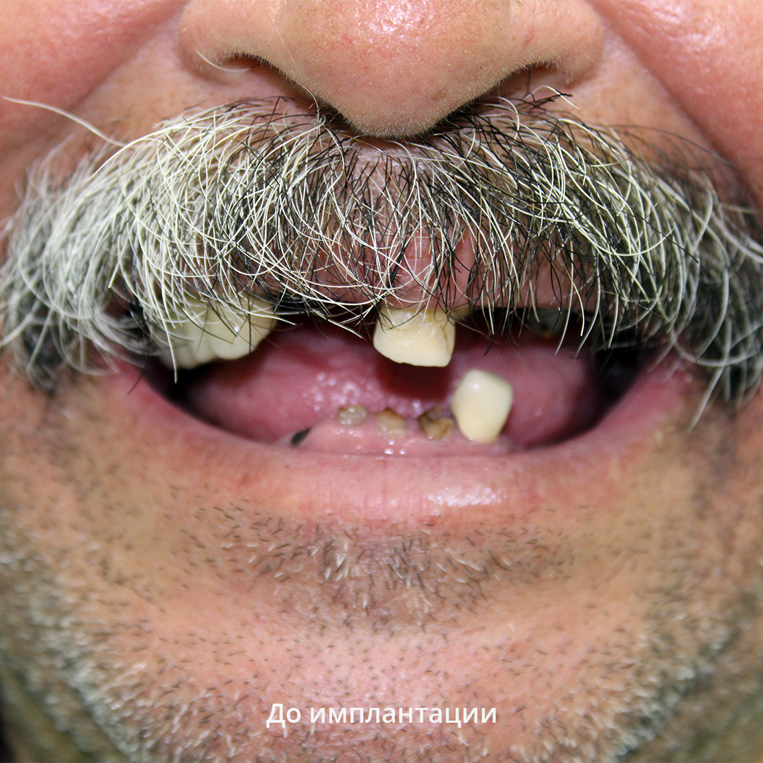 Состояние зубов и эстетика улыбки до имплантации - изображение 1