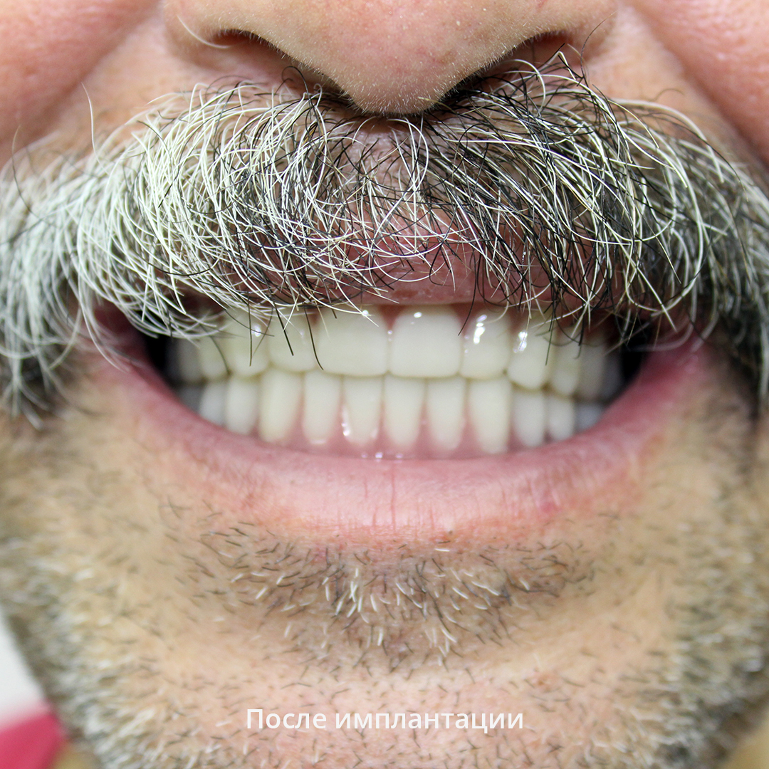 Состояние зубов и эстетика улыбки после имплантации и протезирования