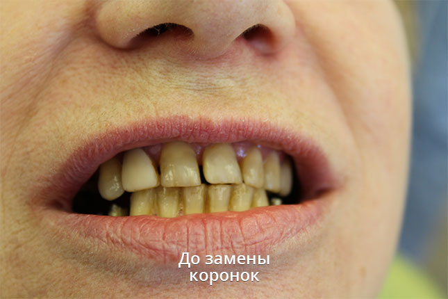 Состояние зубов до замены коронок