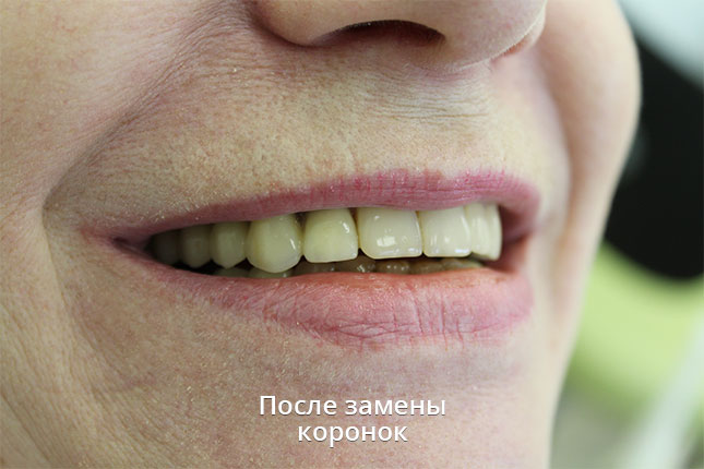 Состояние зубов после замены коронок