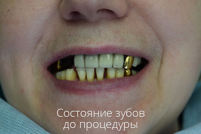 Жукова. Зубы до базальной имплантации