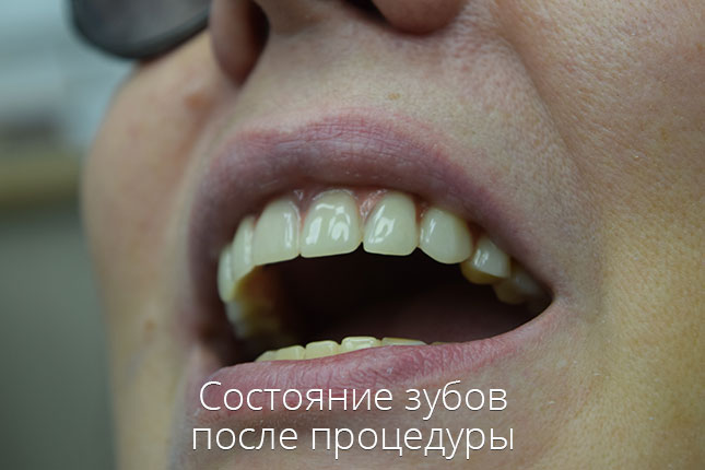 Жукова. Зубы после базальной имплантации